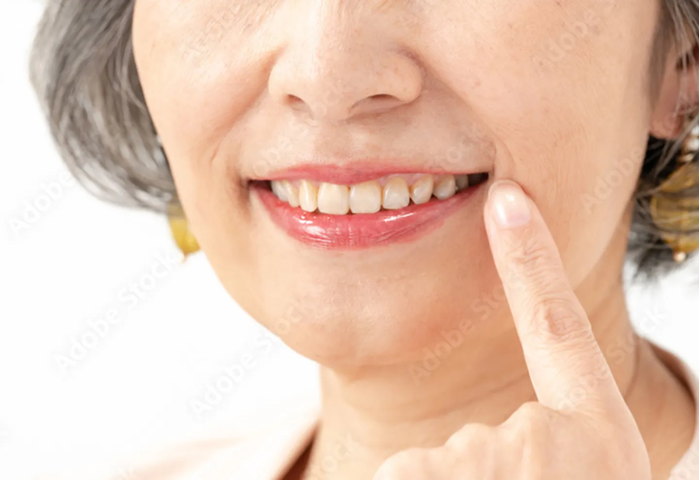 メリットその3:残っている歯を守ってくれる