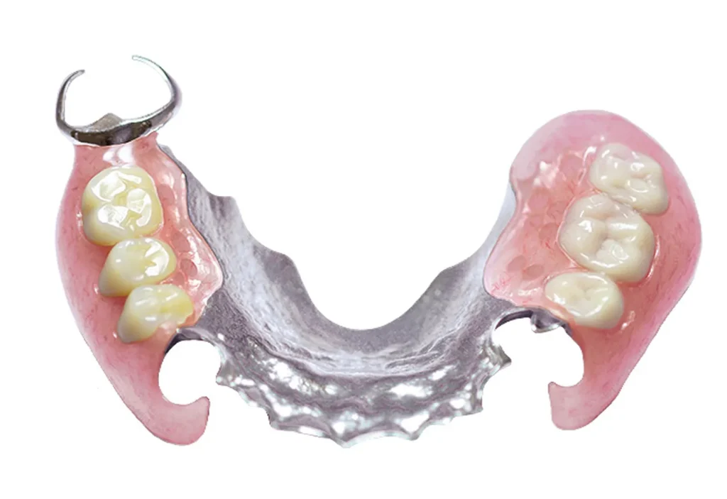 ノンクラスプデンチャー+金属床(部分義歯)